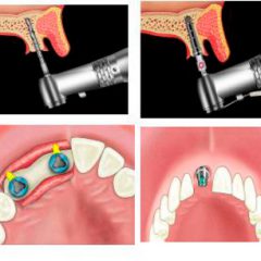Как осуществляется имплантация зубов?
