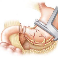 Как выполняют линейную резекцию желудка?