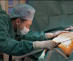 Преимущества водоструйной липосакции