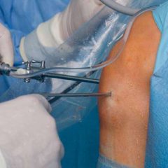 Что такое артроскопия?