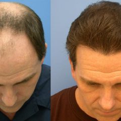 Когда нужно повторять лазерную операцию волос?