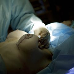 Как проходит операция по увеличению груди?